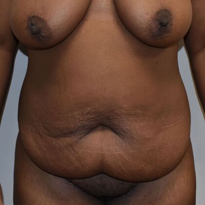 Tummy Tuck (Abdominoplasty): Case 465 - Before