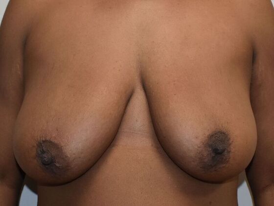 Breast Lift (Mastopexy) Case 194 - Before