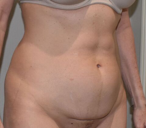 Tummy Tuck (Abdominoplasty): Case 466 - Before