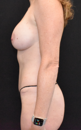 Mommy Makeover: Case 10 - After