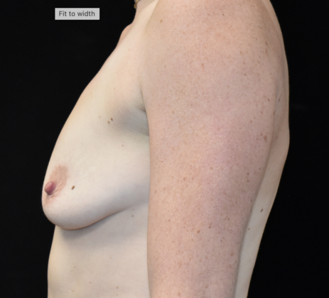 Mastopexy with Augmentation: Case 12 - Before