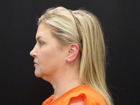 Face & Neck Lifts: Case 34 - Before