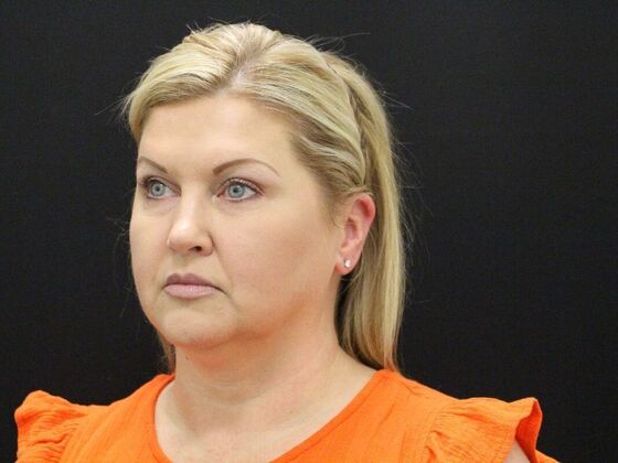 Face & Neck Lifts: Case 34 - Before