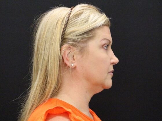 Face & Neck Lifts: Case 34 - Before