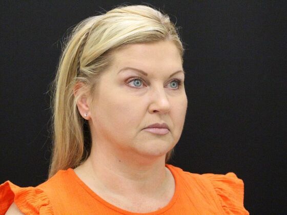 Face & Neck Lifts Case 34 - Before