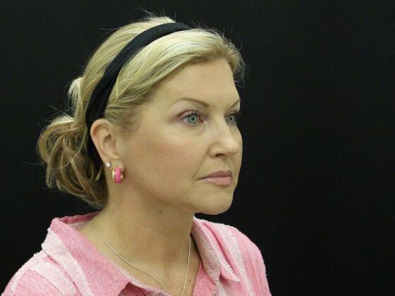 Face & Neck Lifts Case 34 - After