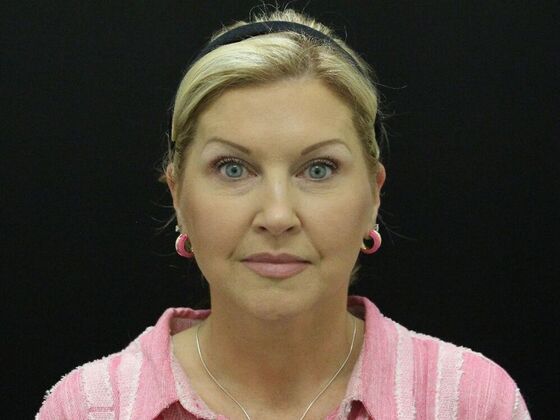 Face & Neck Lifts: Case 34 - After