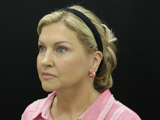 Face & Neck Lifts: Case 34 - After