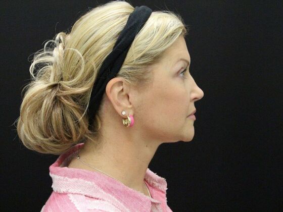 Face & Neck Lifts: Case 34 - After