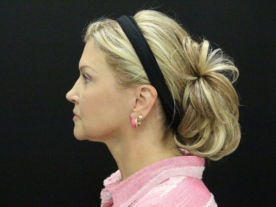 Face & Neck Lifts: Case 34 - After