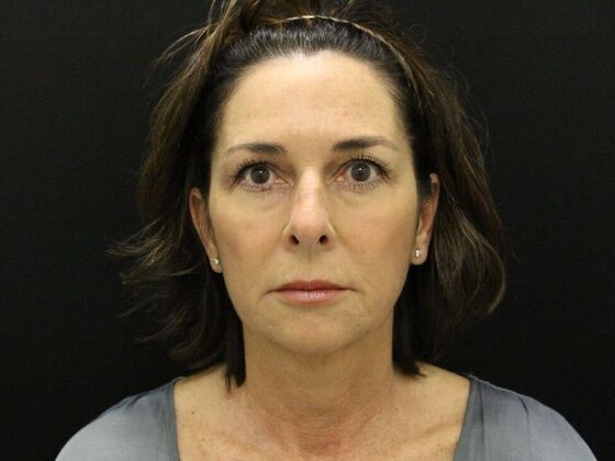 Face & Neck Lifts Case 35 - Before