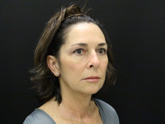 Face & Neck Lifts: Case 35 - Before