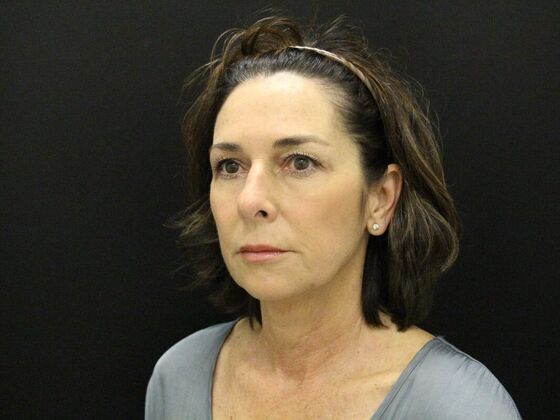 Face & Neck Lifts: Case 35 - Before