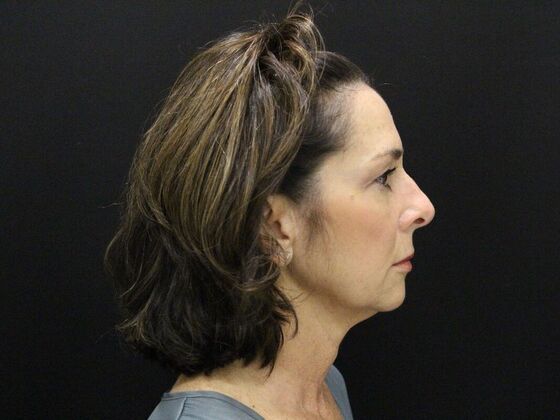Face & Neck Lifts: Case 35 - Before