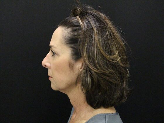 Face & Neck Lifts: Case 35 - Before