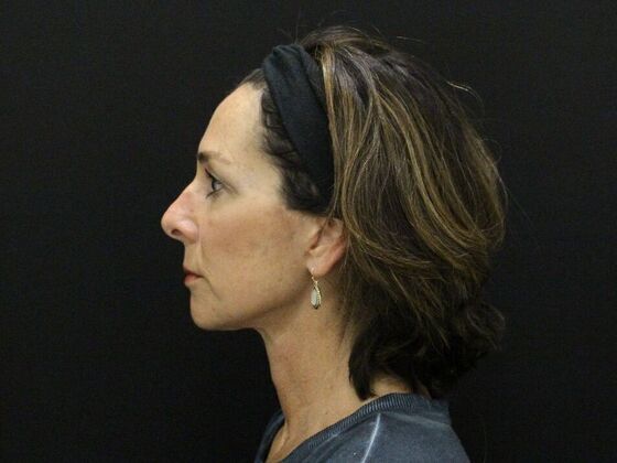 Face & Neck Lifts: Case 35 - After