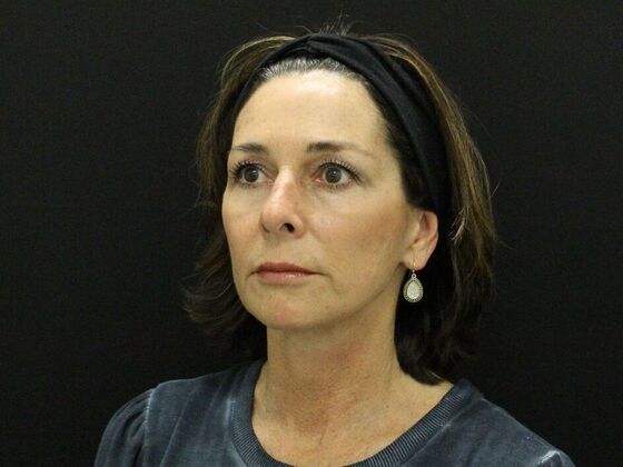 Face & Neck Lifts: Case 35 - After