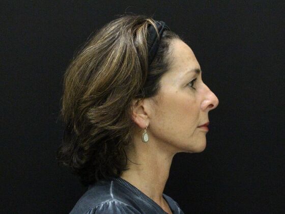 Face & Neck Lifts: Case 35 - After