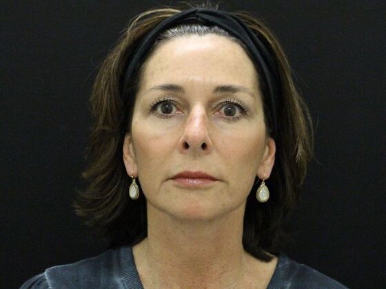 Face & Neck Lifts Case 35 - After