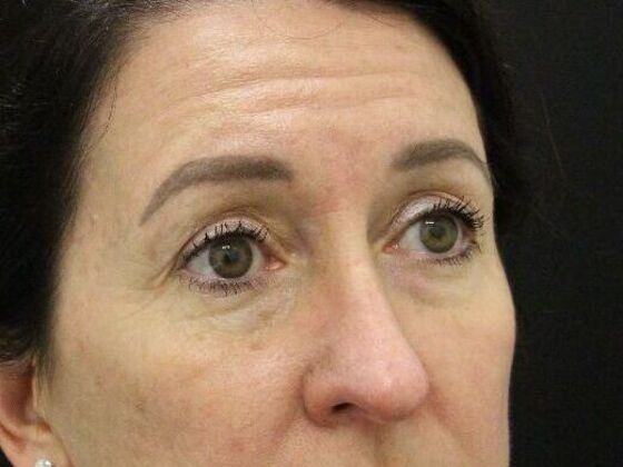 Eyelid Surgery Case 12 - Before