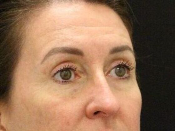 Eyelid Surgery Case 12 - After