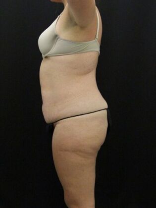 Tummy Tuck: Case 63 - Before