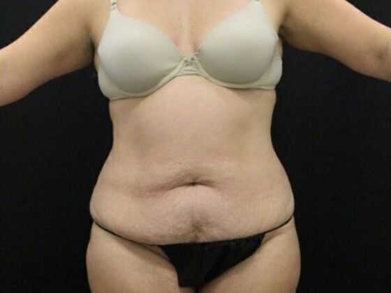 Tummy Tuck Case 63 - Before