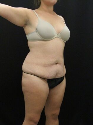 Tummy Tuck: Case 63 - Before