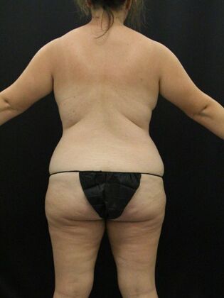 Tummy Tuck: Case 63 - Before