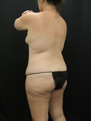 Tummy Tuck: Case 63 - Before