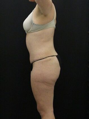 Tummy Tuck: Case 63 - After