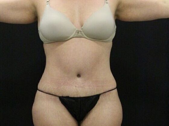Tummy Tuck Case 63 - After