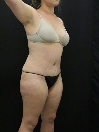 Tummy Tuck: Case 63 - After