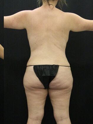 Tummy Tuck: Case 63 - After