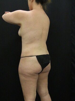 Tummy Tuck: Case 63 - After