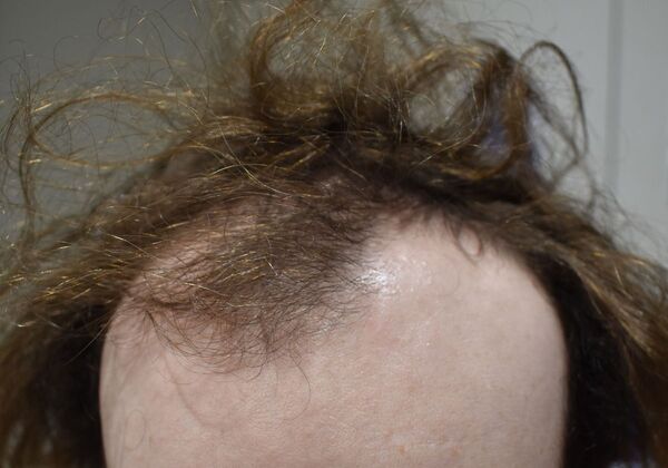 Hair Transplantation Case 5 - Before