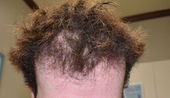 Hair Transplantation Case 5 - After