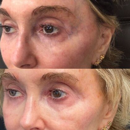 Periorbital Vein removal  Case 1