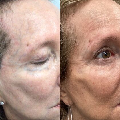 Periorbital Vein removal  Case 2