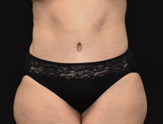 Abdominoplasty Case 13 - After