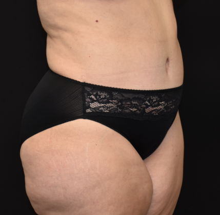 Abdominoplasty: Case 13 - After