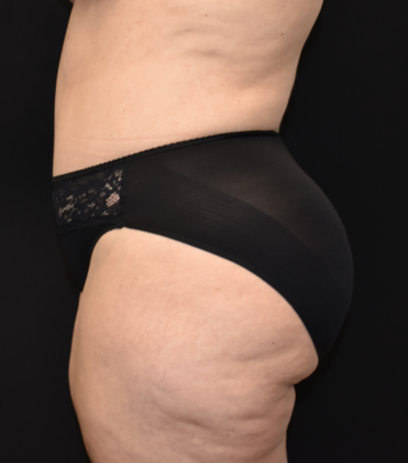 Abdominoplasty: Case 13 - After