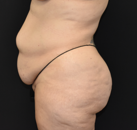 Abdominoplasty: Case 13 - Before