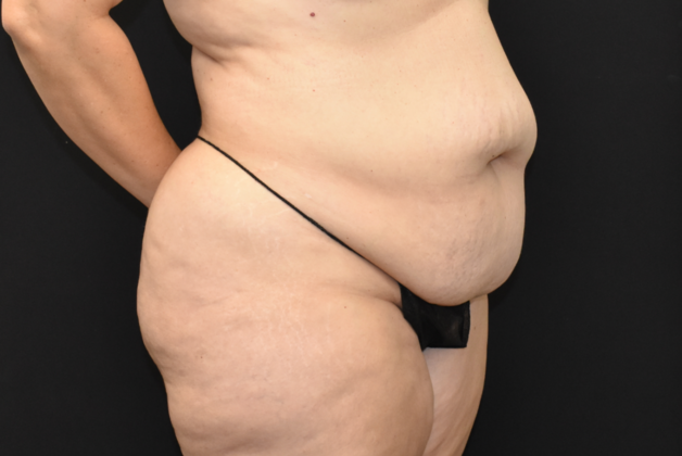 Abdominoplasty: Case 13 - Before