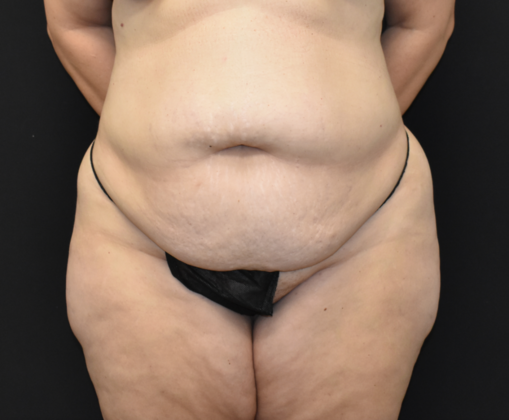 Abdominoplasty Case 13 - Before