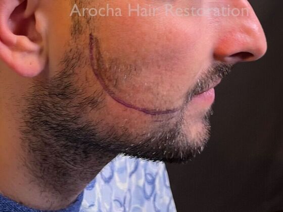 Facial Hair Transplantation: Case 14 - Before