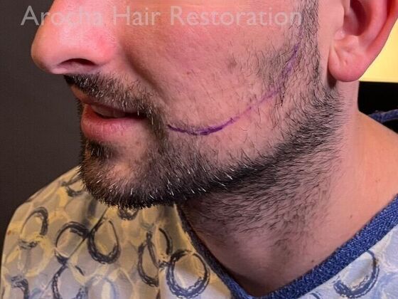 Facial Hair Transplantation: Case 14 - Before