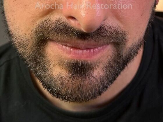 Facial Hair Transplantation Case 14 - After