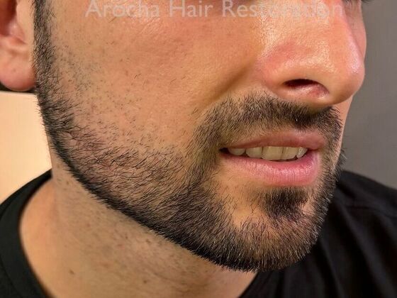 Facial Hair Transplantation: Case 14 - After