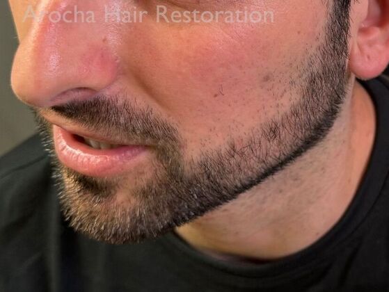 Facial Hair Transplantation: Case 14 - After